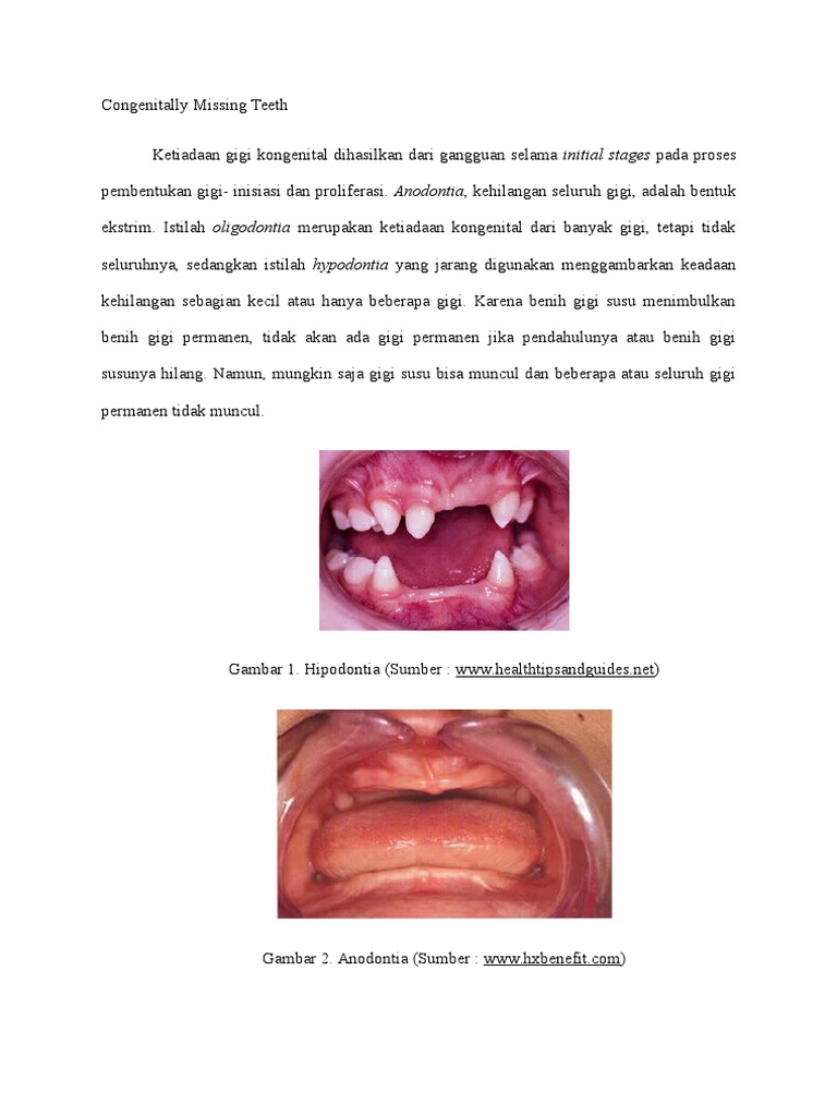 Congenitally Missing Teeth | PDF | Sains & Matematika