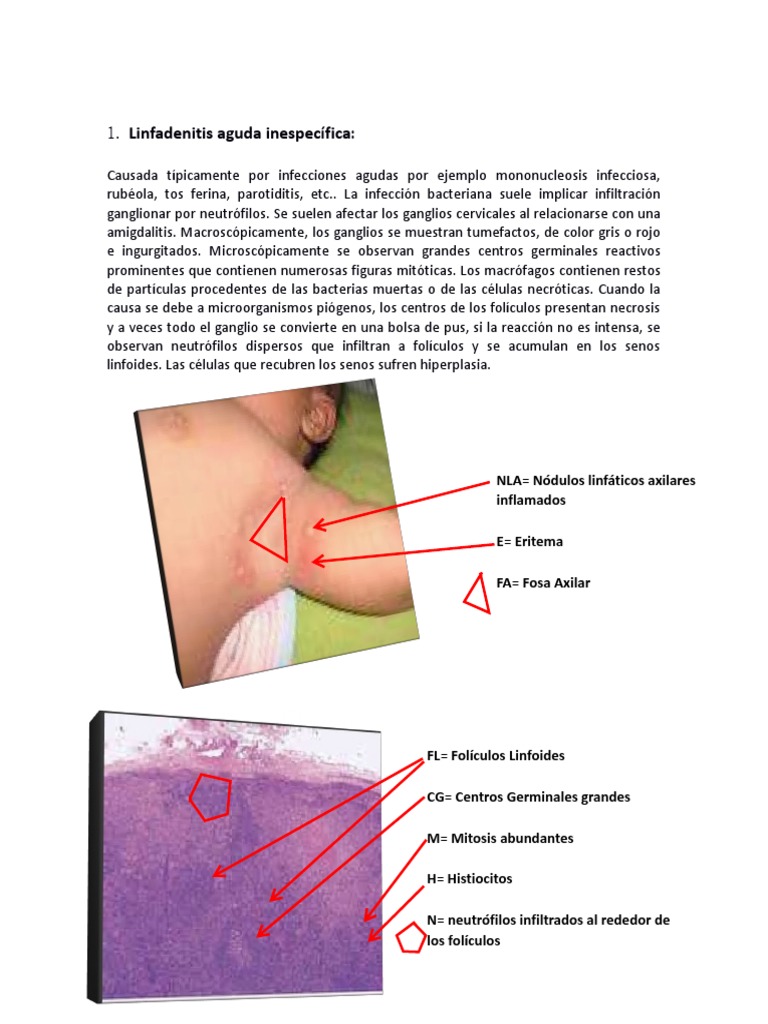 Linfadenitis y Linfoma H y LNH by David Paz Fotografias Ganglio | PDF |  Ganglio linfático | Linfocitos, image size:768x1024