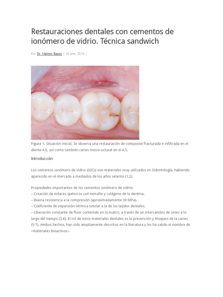 Restauraciones Dentales Con Cementos de Ionómero de Vidrio | Diente ...