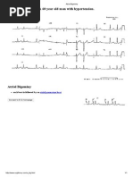 A 60 Year Old Man With Hypertension.: Each Beat Is Followed by An