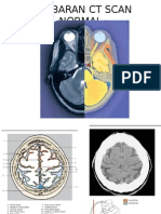 Gambaran CT Scan Normal