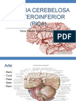 Arteria Cerebelosa Posterio Inferior 