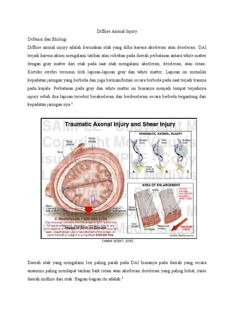 Diffuse Axonal Injury 2 | PDF
