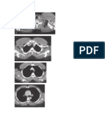 Anatomía Tomografica Del Tórax