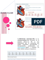 Fibrilación auricular: causas, síntomas y tratamiento