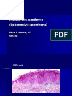 Acantholytic Acanthoma (Epidermolytic Acanthoma),M 65, Neck
