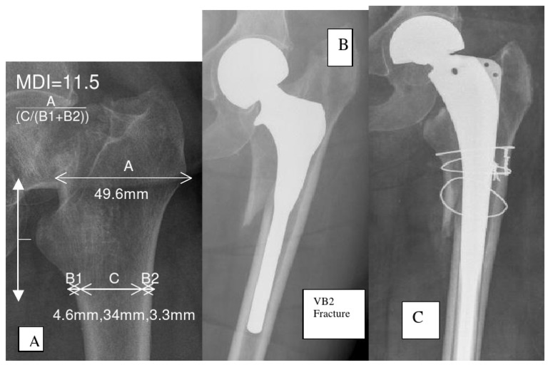 MDI Calculation and Fracture Analysis | PDF