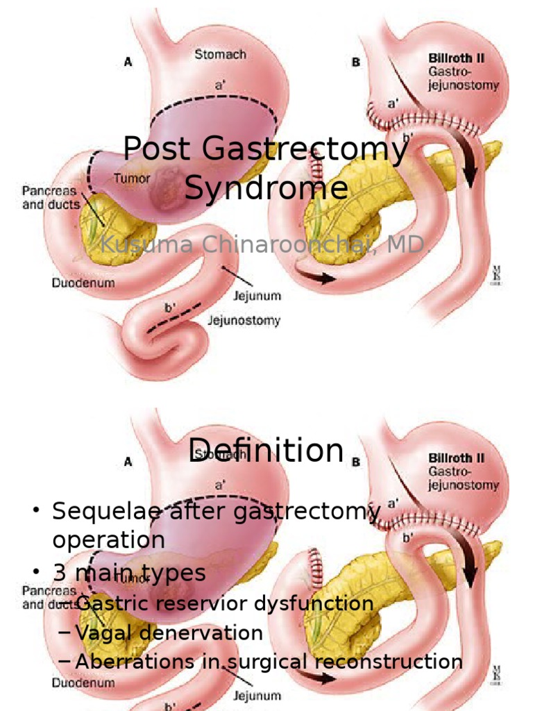 Post Gastrectomy Syndrome PDF Vitamin B12 Stomach