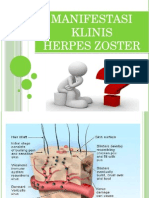 Herpes Zoster Ppt