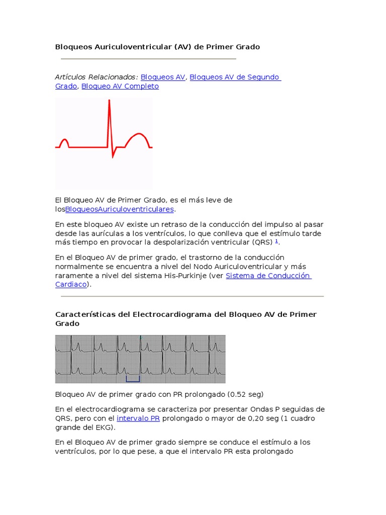 Bloqueos Auriculoventricular