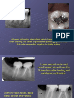Cracked Tooth Presentation