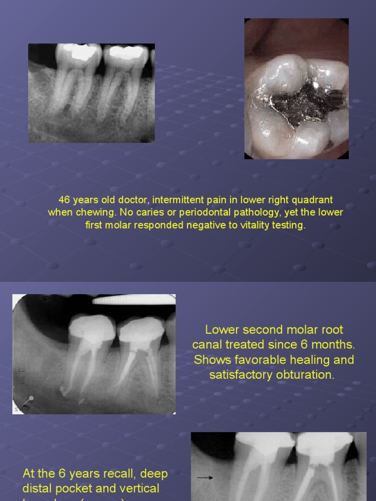 Cracked Tooth Presentation | PDF | Tooth | Dentistry Branches