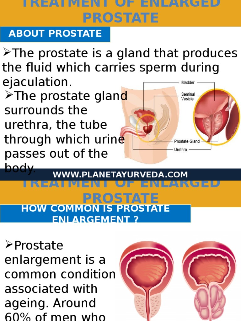 Ayurvedic Treatment of Enlarged Prostate Gland PDF Prostate