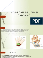 Sindrome Del Tunel Carpiano