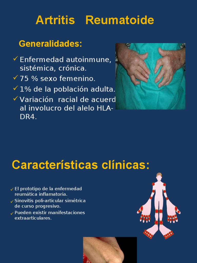 Artritis Reumatoide Artritis reumatoide Medicina clínica