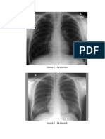 Gambar Radiologi TB