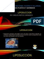 Liposuccion CARLOS MATOS