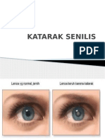 Katarak Senilis