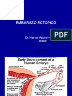 Embarazo Ectopico