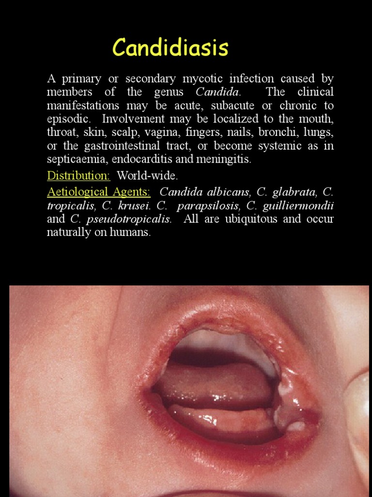 Candidiasis: Distribution: Aetiological Agents | PDF