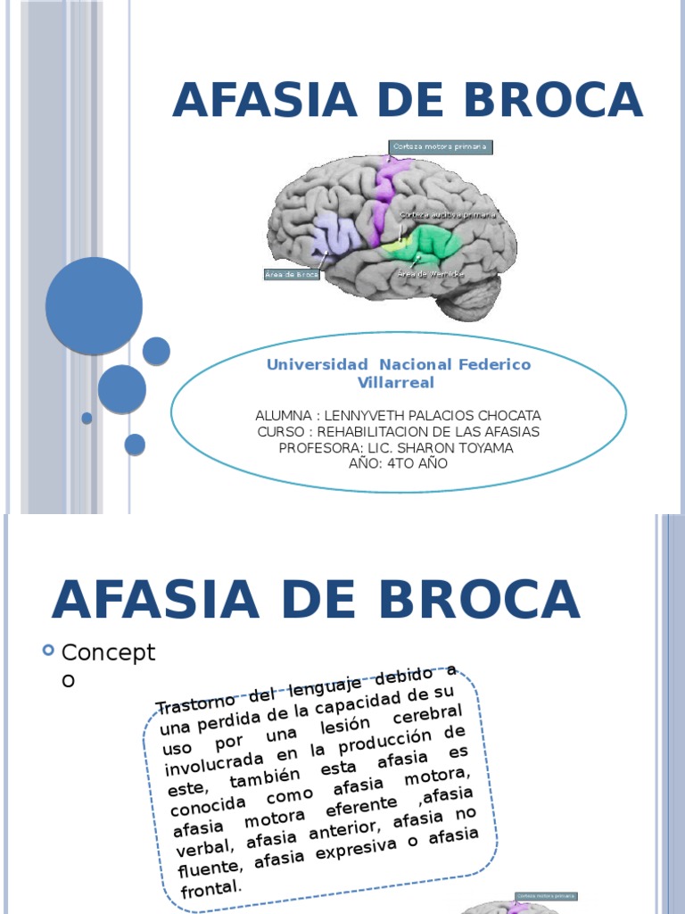 Afasia de Broca (1) Afasia Neurología