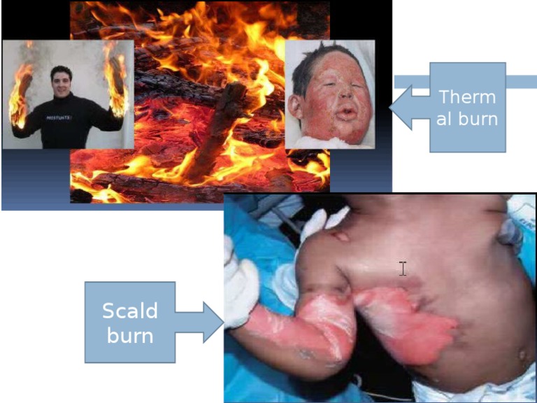 Understanding Thermal Burns | PDF