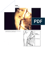 Coronary Heart Disease.: (Slide Courtesy of Dr. Hutton - Circa 1978)