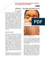 Surgery For Nasal Dermoids PDF