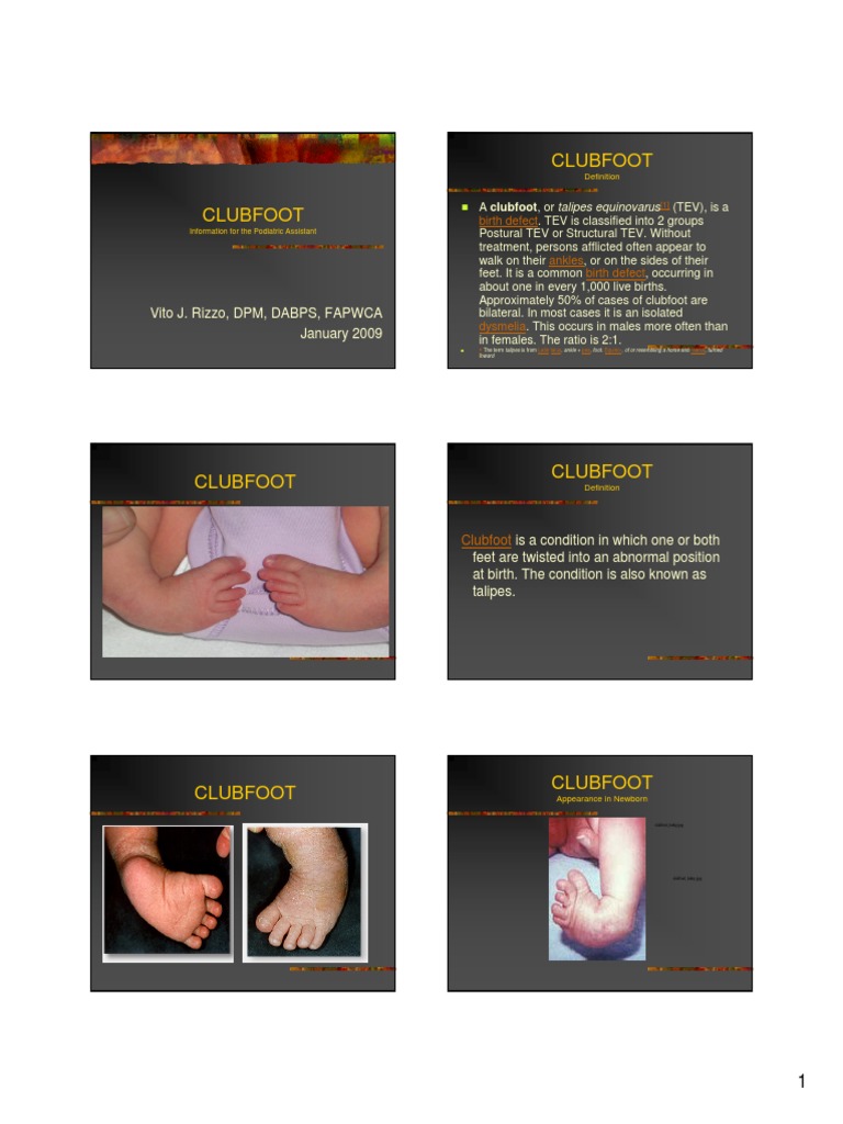 Clubfoot: Vito J. Rizzo, DPM, DABPS, FAPWCA January 2009 | PDF ...