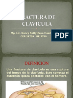 Fractura de Clavicula.