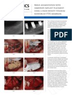 Ridge Augmentation With Immediate Implant Placement Using A High-Density Titanium-Reinforced PTFE Membrane
