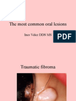 cele mai comune leziuni orale