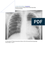 A. PA Chest Radiograph Demonstrates Prominent Dilation of The Left Atrial Appendage Secondary To Partial Absence of The Pericardium