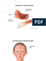 Quemadura de Tercer Grado