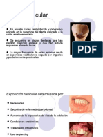 Caries Radicular