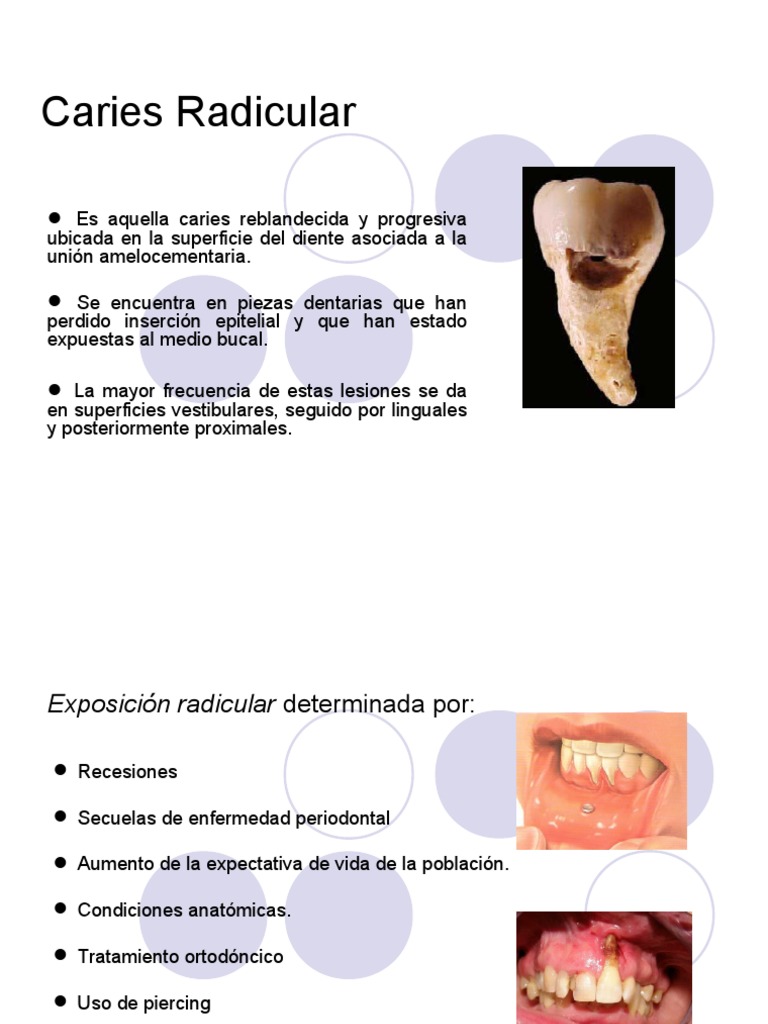 Caries Radicular | PDF | Diente humano | Enfermedades y trastornos