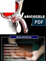 Varicocele (1)