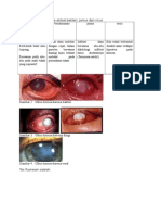 Perbedaan Ulkus Kornea Akibat Bakteri