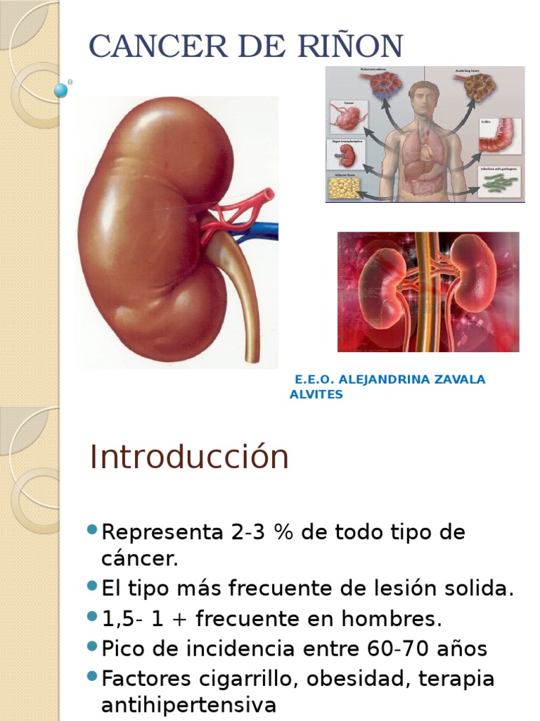 Cáncer de Riñon | PDF | Metástasis | Cáncer
