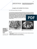 Hepatomegaly Multiple: and Liver Lesions