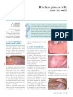 Il Lichen Planus Delle Mucose Orali