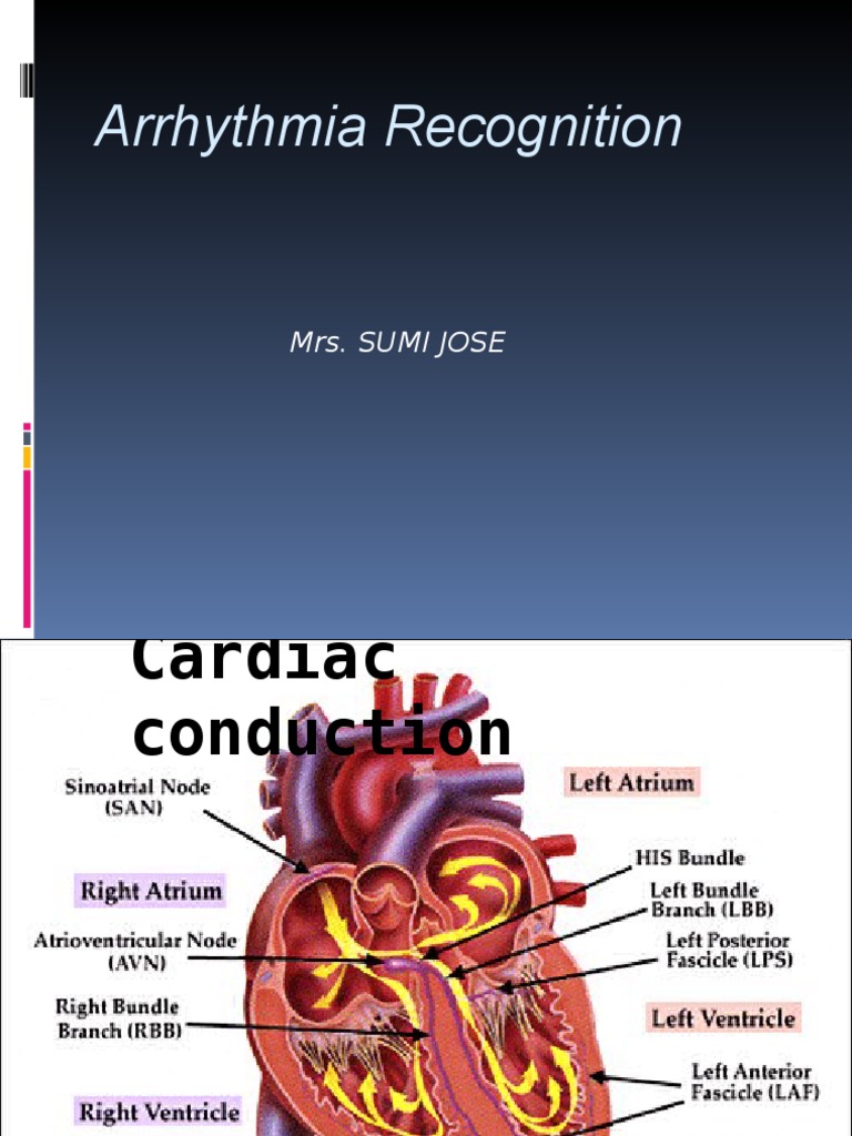 Approach To Arrythmia Recognition | Download Free PDF | Cardiac ...
