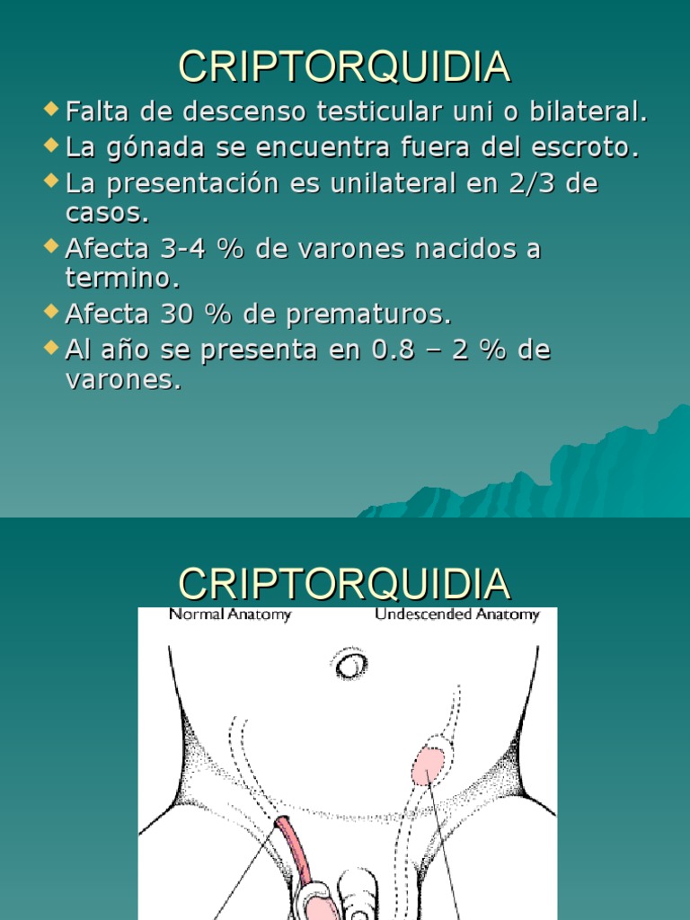 Criptorquidia: Definición y Tratamiento | PDF