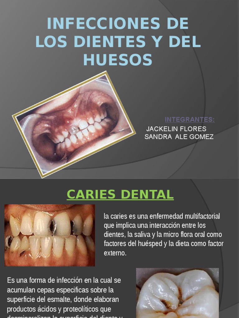 Infecciones de Los Dientes y Del Huesos | Diente humano | Esmalte de ...