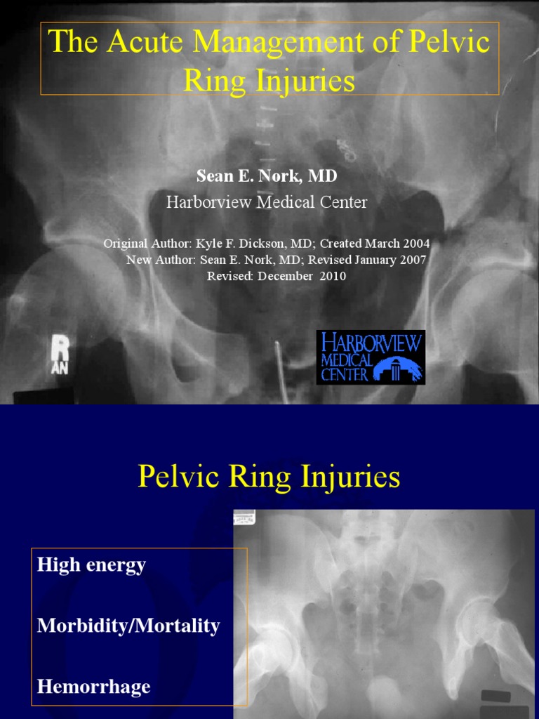 V02 acute mgmt pelvic ring – pelvic ring fractures – FIOGN