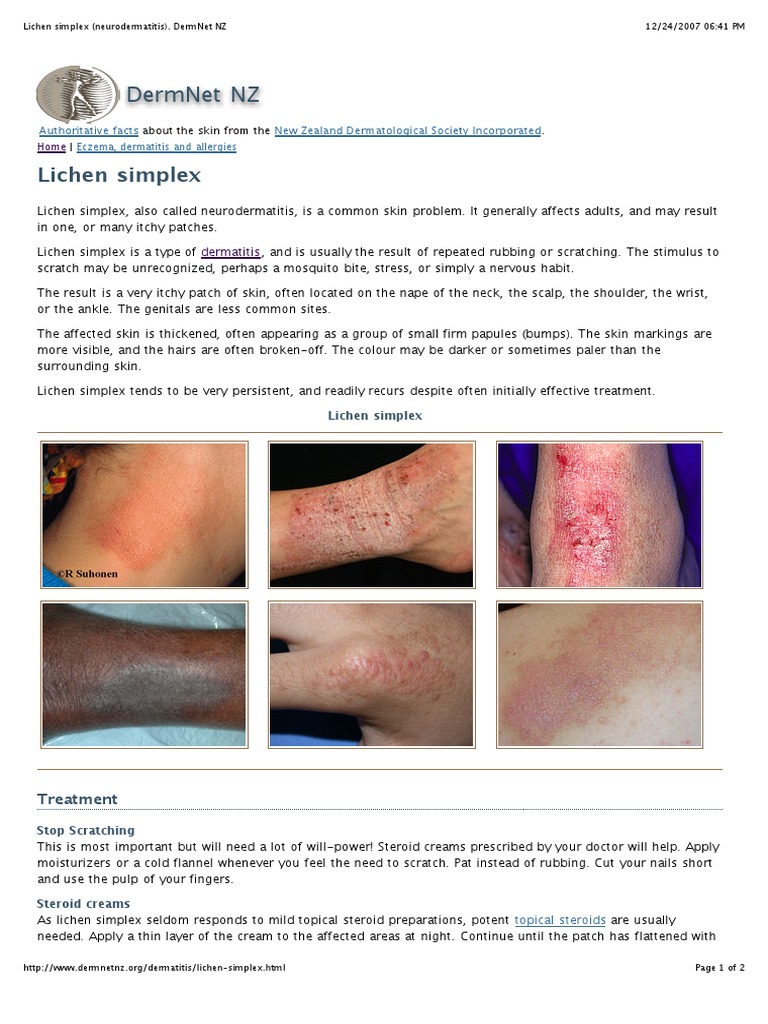 Lichen Simplex / Neurodermatitis Dermatitis Dermatology