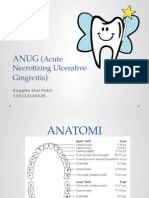 ANUG (Acute Necrotizing Ulcerative Gingivitis)