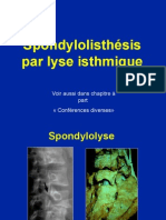  Spondylolisthésis 