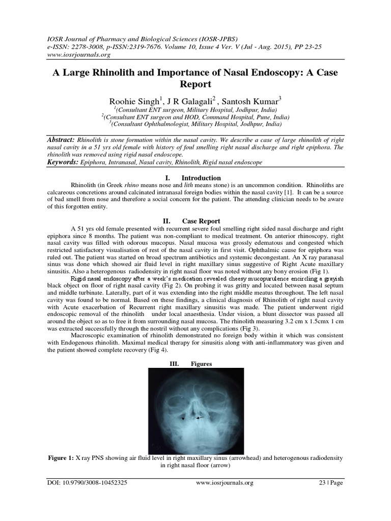 A Large Rhinolith and Importance of Nasal Endoscopy A Case Report