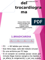 Electrocardiogramaanormal